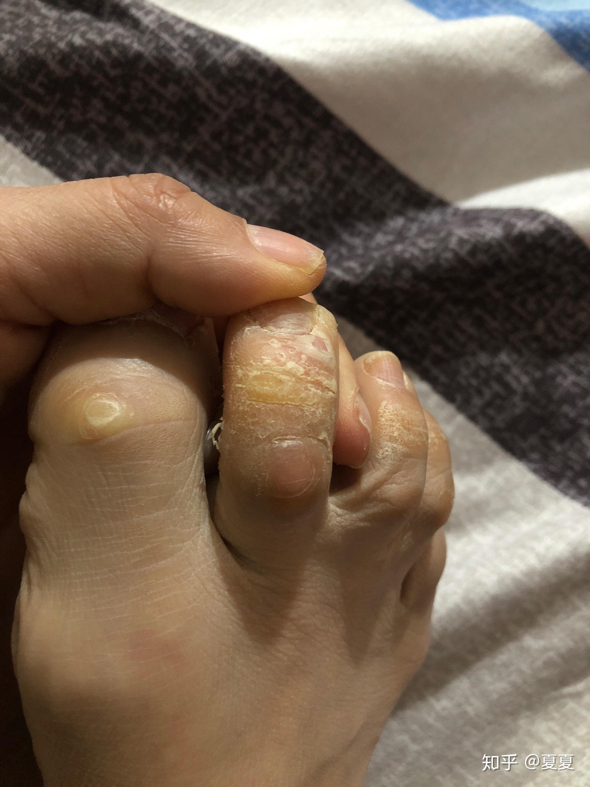 脚指头上有两道沟偶尔会特别痒有时候会肿肿完会变