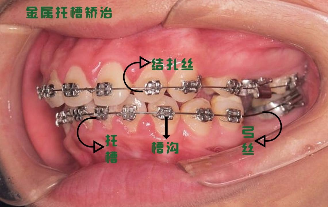看了表格,对各种正畸托槽装置是什么样的,毫无头绪?