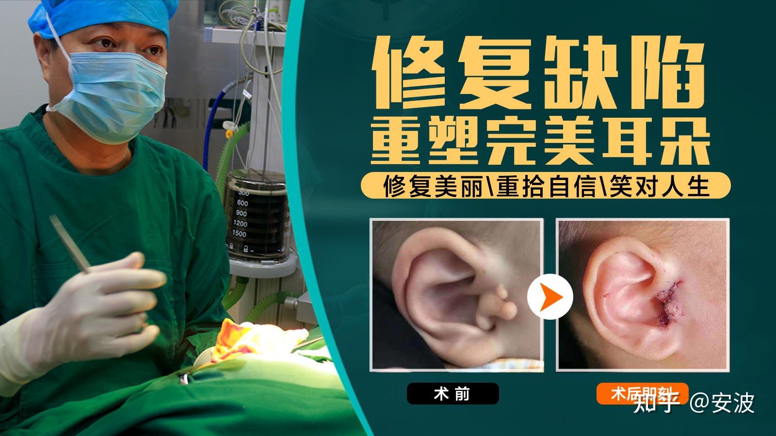 景丽峰医生：耳垂修复手术多大可以做？图解几种耳垂畸形修复术！ - 知乎