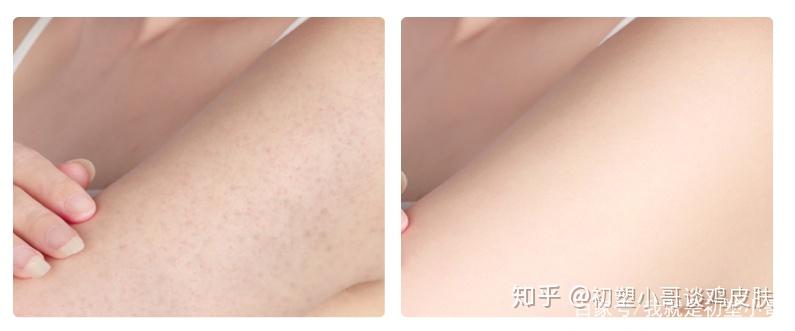 鸡皮肤用激光去色素(激光能去鸡皮肤上的色素)