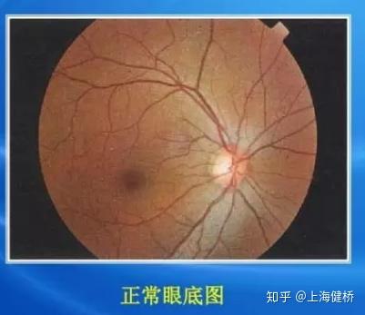 眼底病有哪些眼底病视力能恢复吗 知乎 眼底病有哪些眼底病视力能恢复吗 知乎