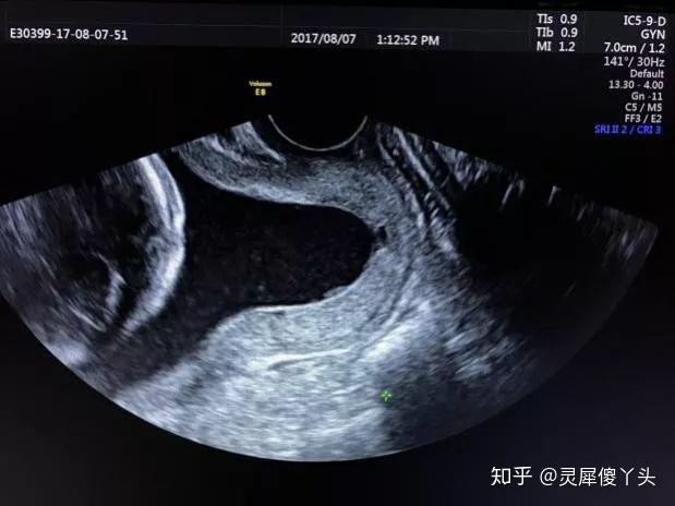 刘铭医生环扎手术攻略