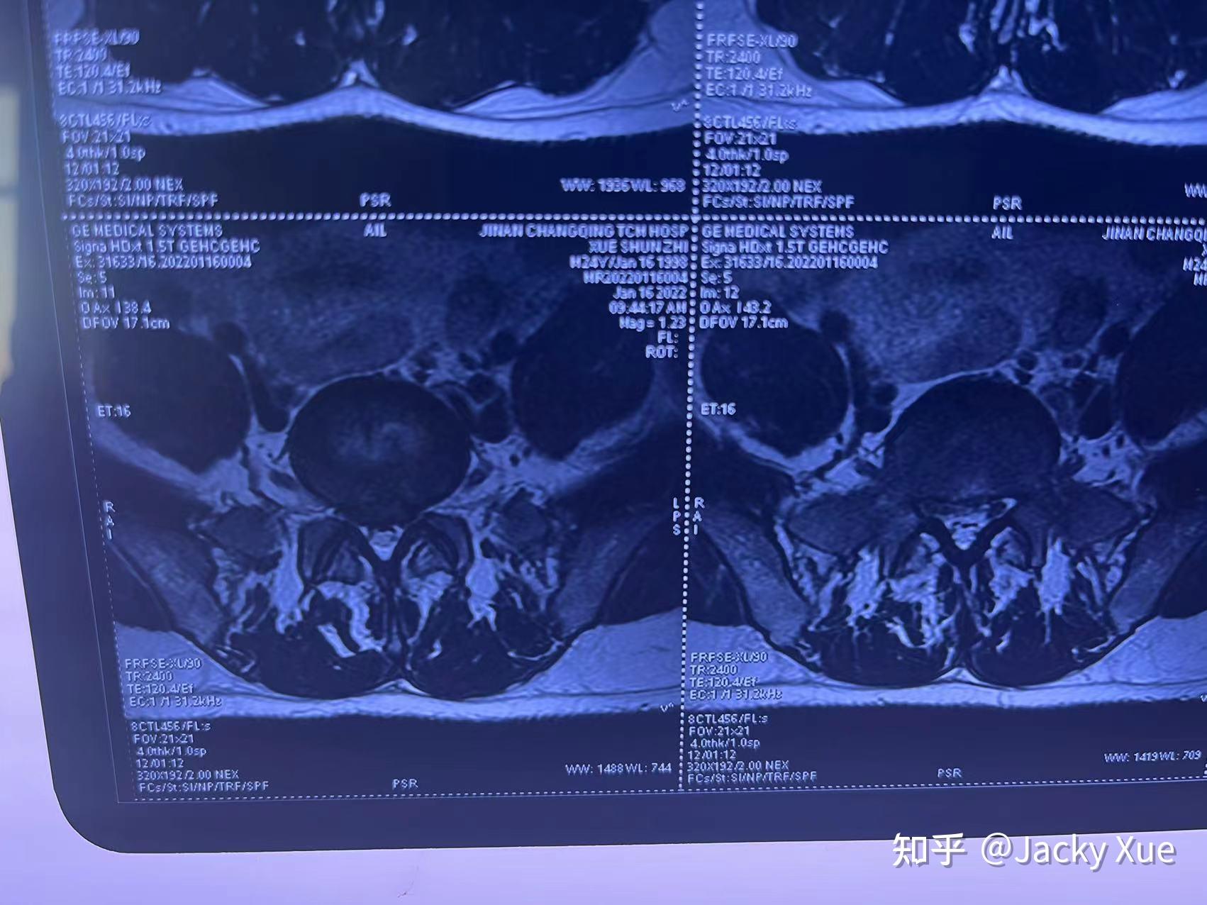 23歲l5s1腰椎間盤突出脫出引起腳麻的4個月記錄