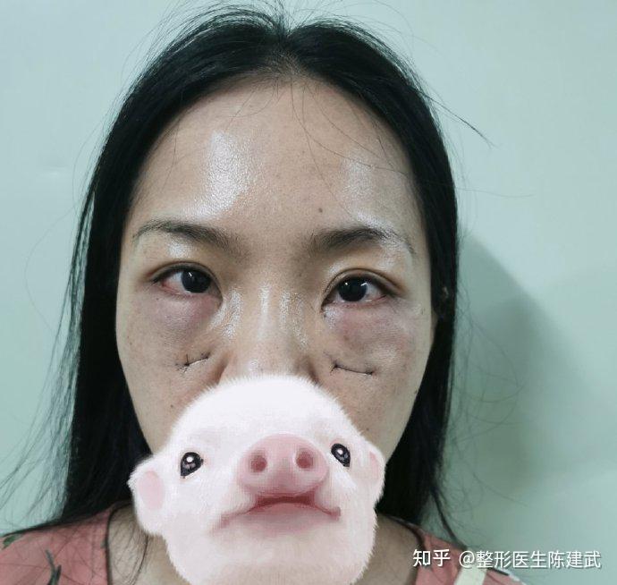 眼袋手术第1天会不会很肿能出门吗