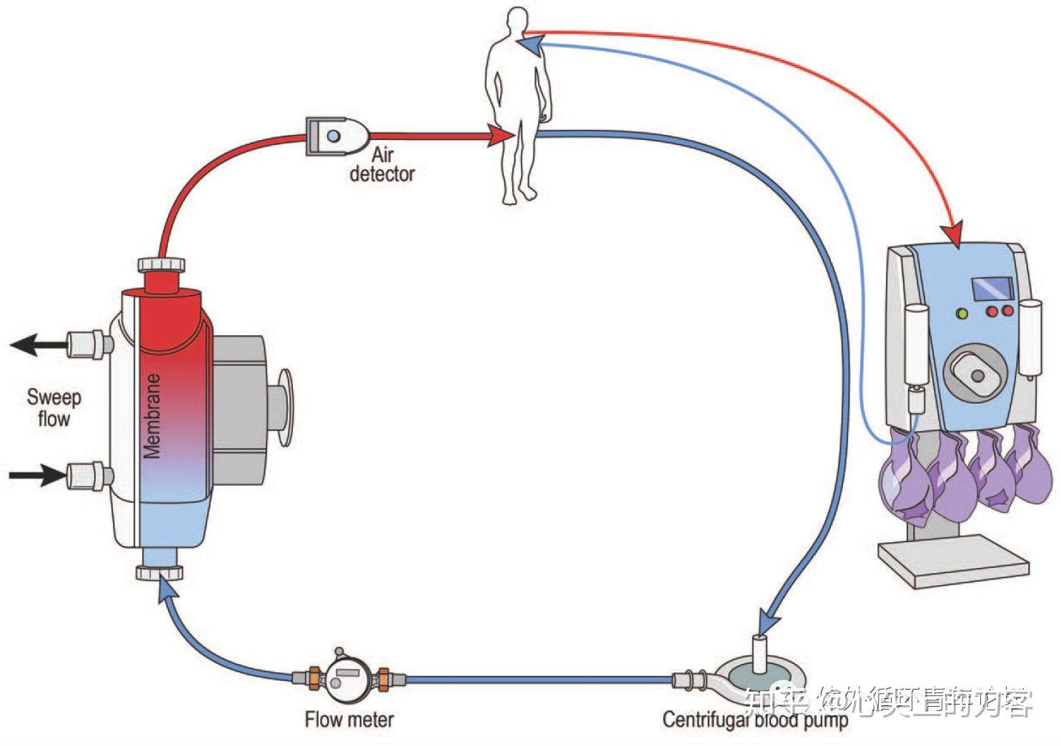 连接方式包括将血液过滤器直接接入ecmo管路.这种连接方式预充量较小.