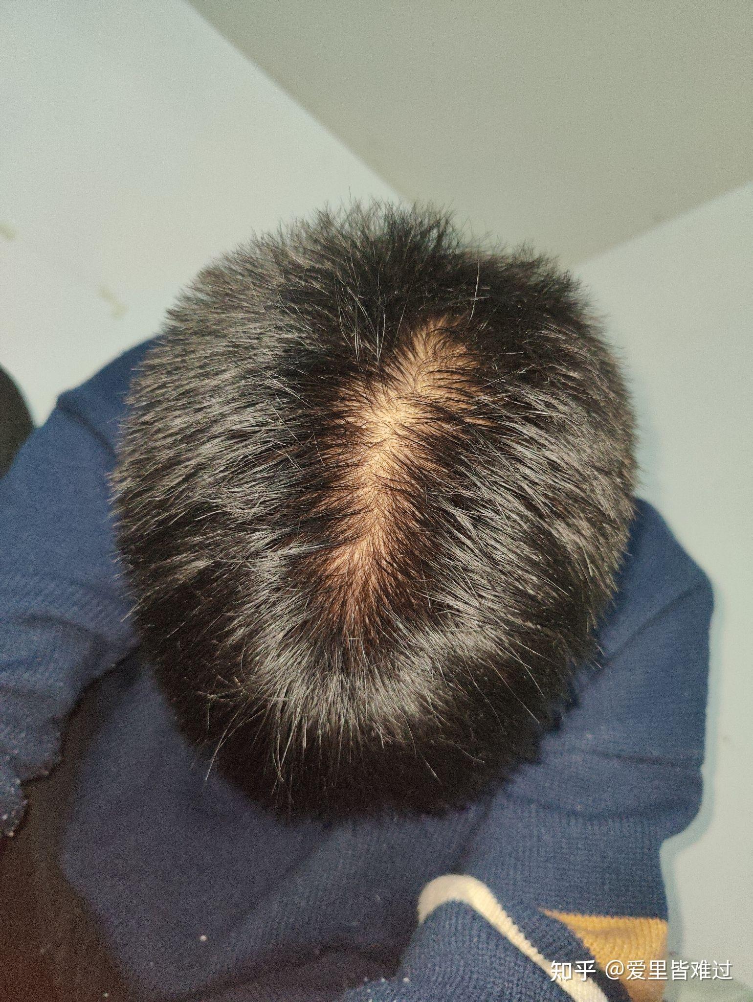 脂溢性脱发－广东省中医院治疗之旅 - 知乎