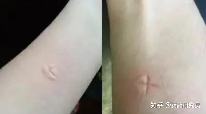 皮肤痒就爱忍不住抓,皮肤搔抓障碍竟是一种强迫症? - 知乎