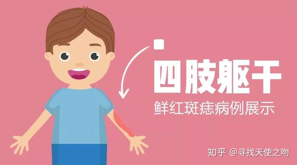 复美达光动力治疗鲜红斑痣疗效展示