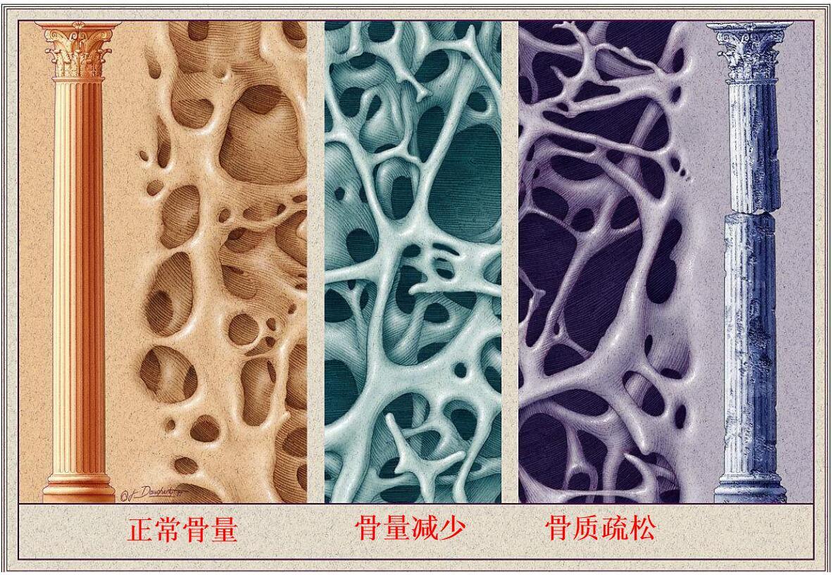 骨质疏松预防与治疗 - 知乎