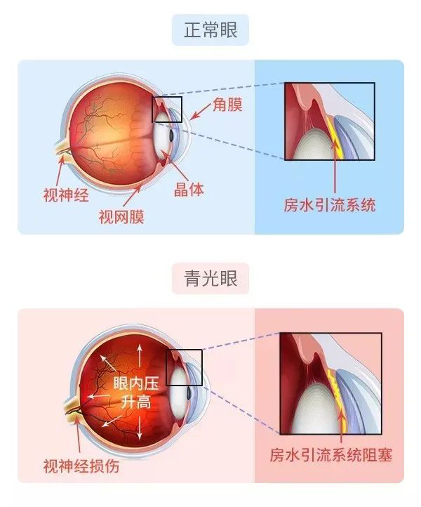 急性闭角型青光眼分期图片