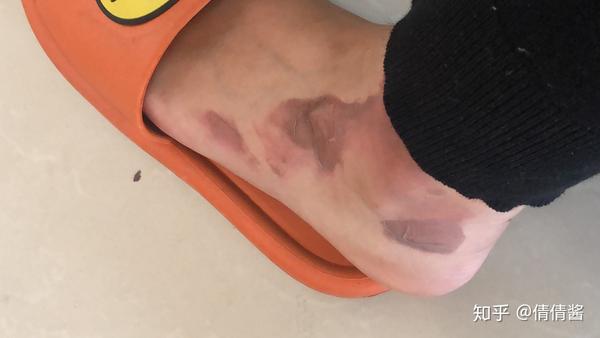 浅二度烫伤的恢复过程【带图完整版】