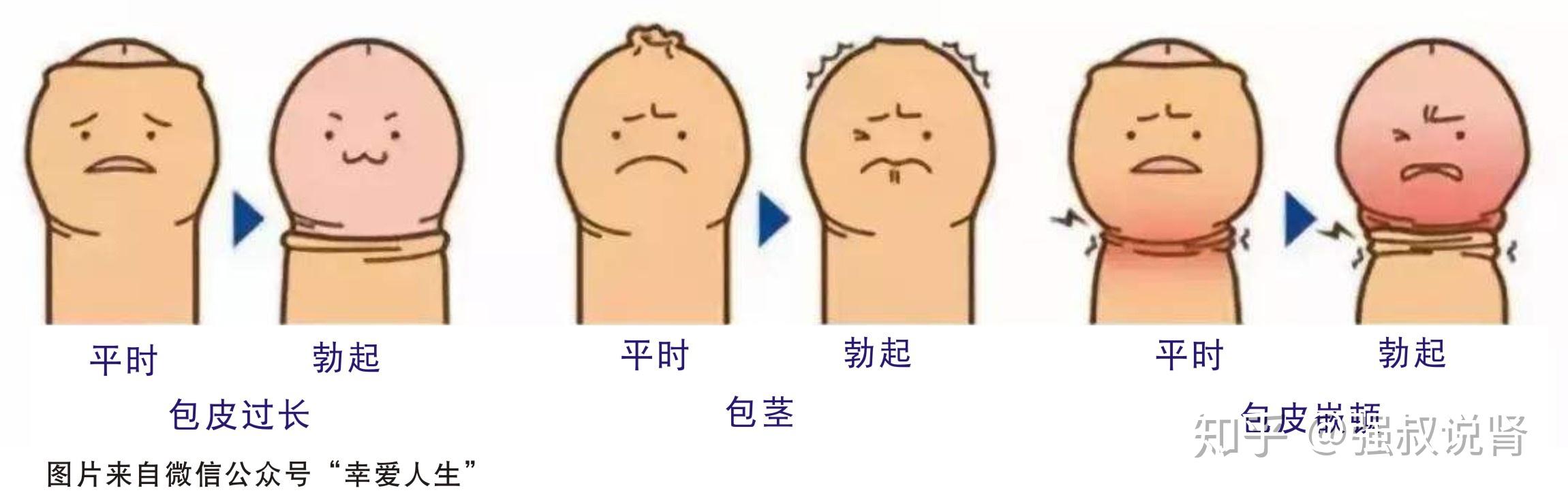 包茎龟头突然漏出来,包皮缩不回去,扣得很紧,很难受,怎么办? - 知乎