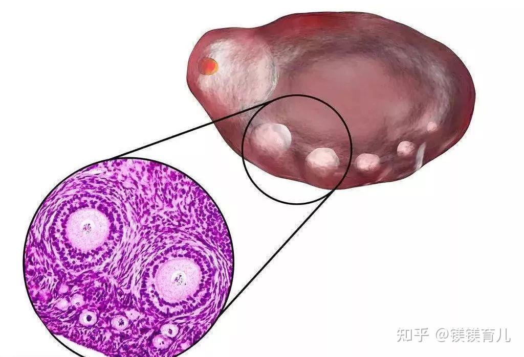 否则就会造成长期或暂时的无排卵,尤其是成熟卵泡本身的激素环境对