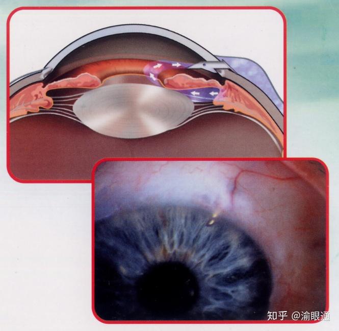青光眼手术治疗的目的仍然是为了控制眼压,延缓或阻止进一步的视力