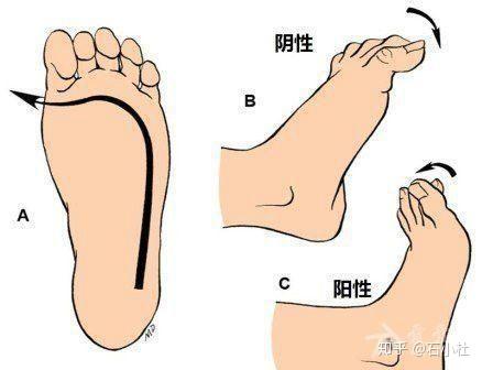 巴宾斯基反射阳性图片