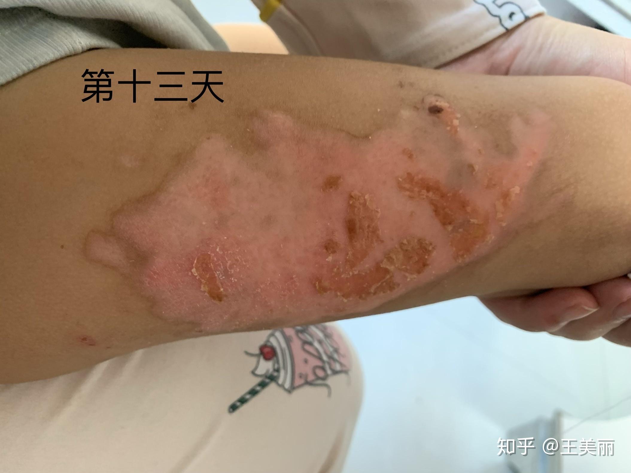 纪录两岁半宝宝开水烫伤恢复过程 - 知乎