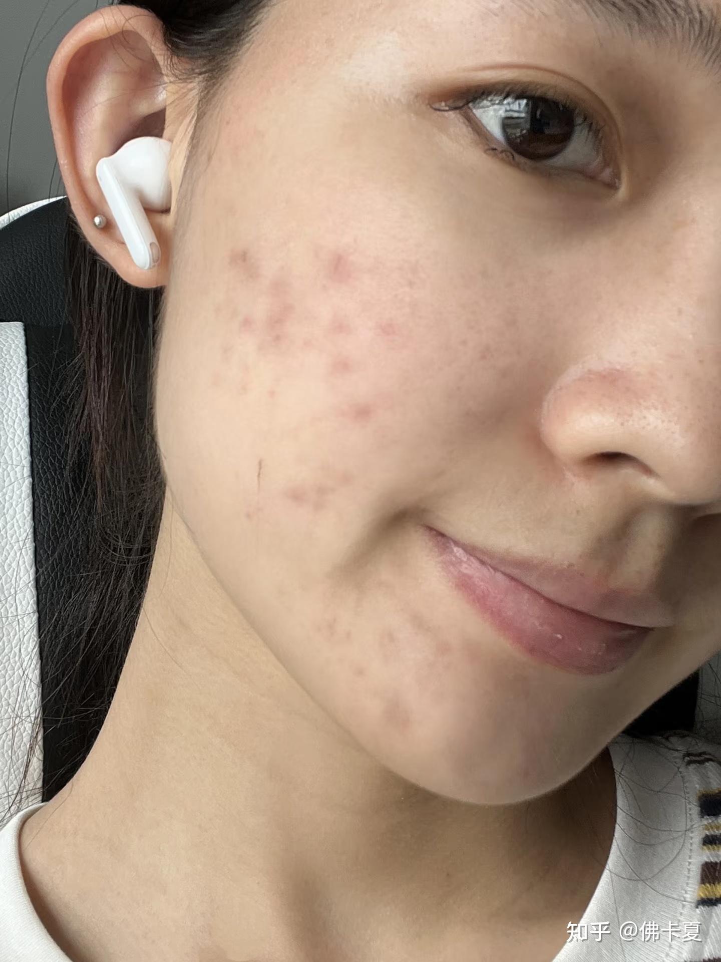 脸上爆痘之后留下很多深色痘印,到底应该怎么办?