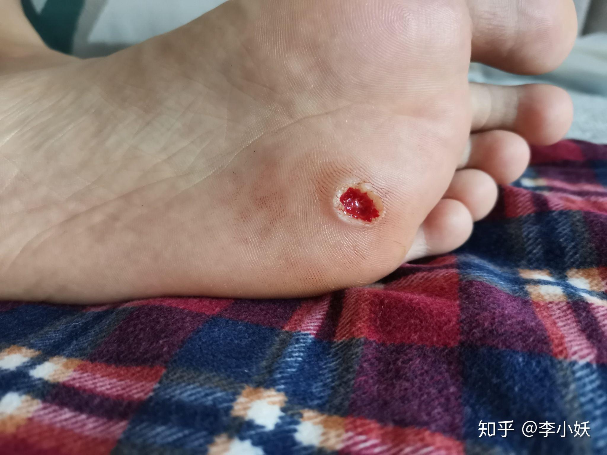 跖疣激光去除经过