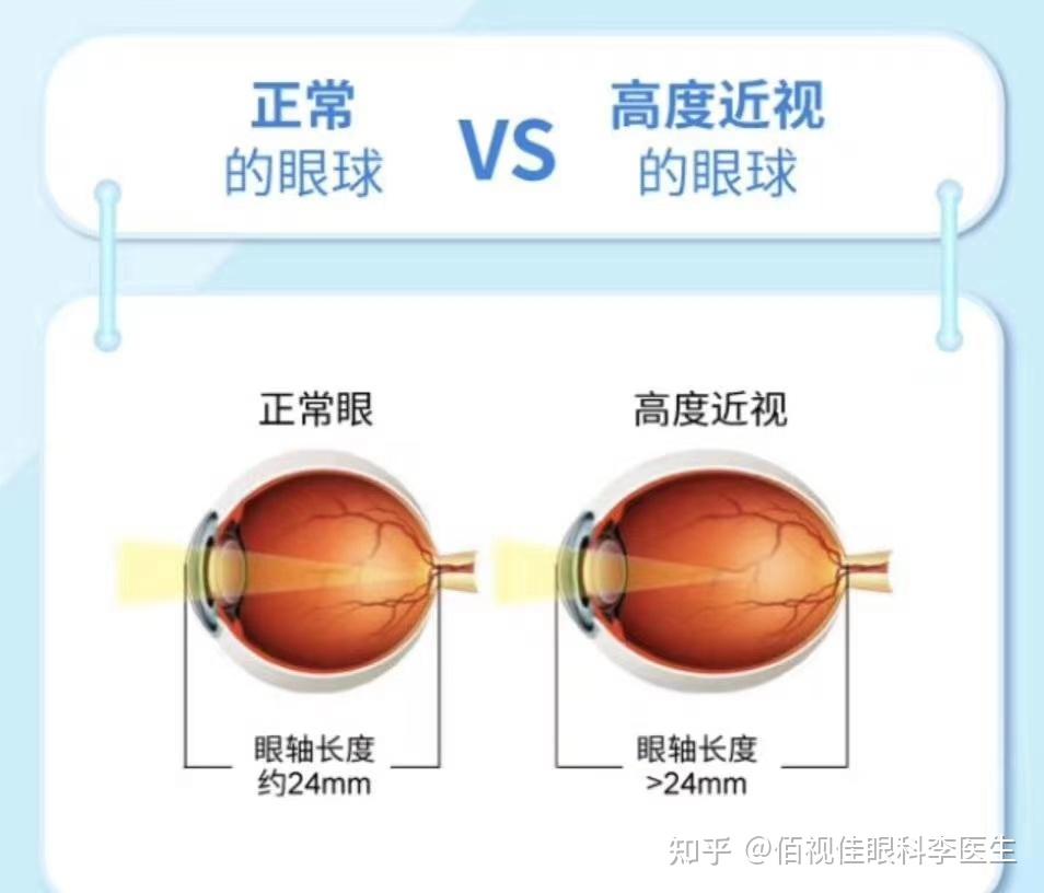 近视眼手术会反弹or在近视吗