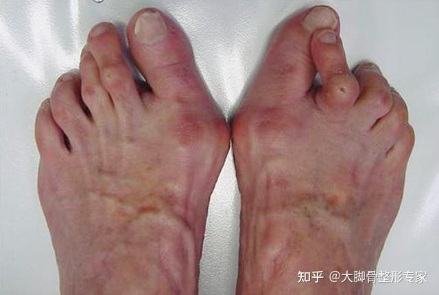 这是特别严重的拇外翻畸形你可能没有看过慎入