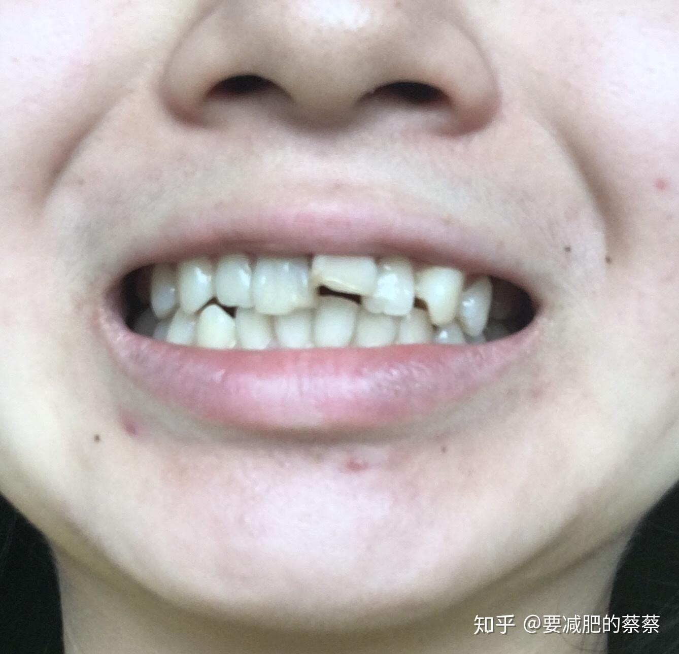 门牙外伤艰难的牙套史