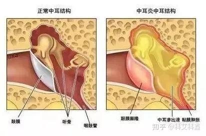 突然耳朵疼是什么原因呢 知乎