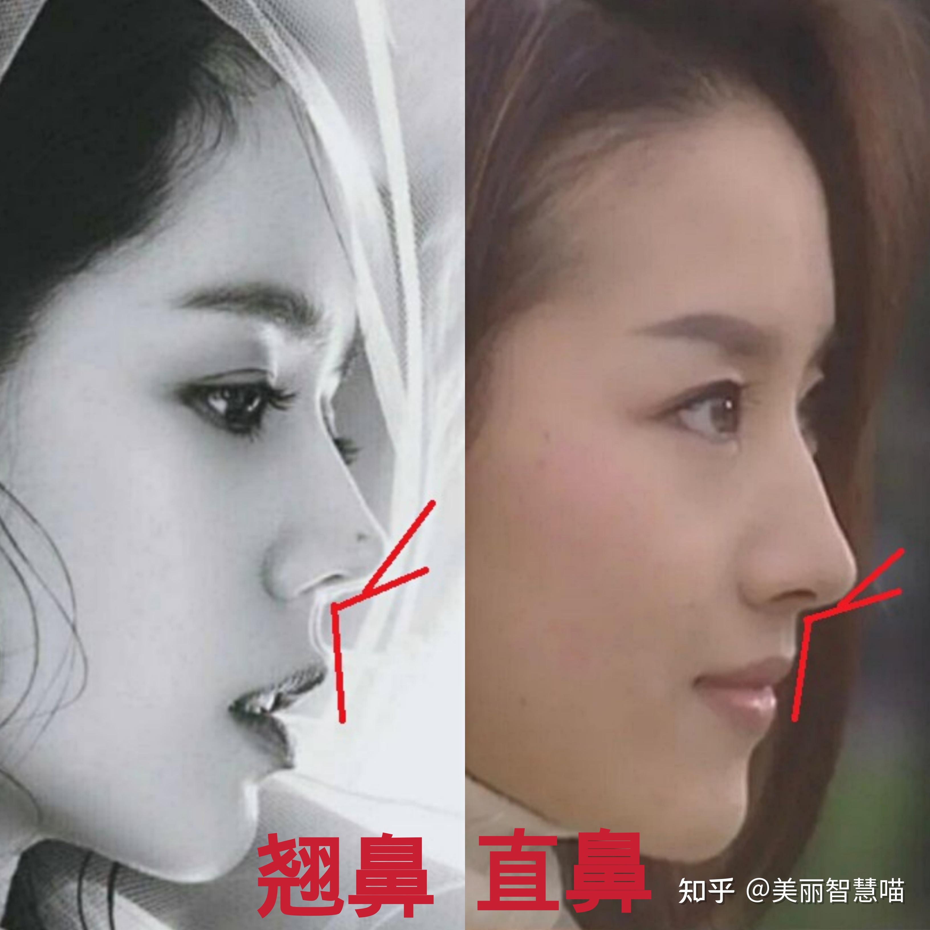 干货隆鼻前必须知道的鼻尖形态审美细节