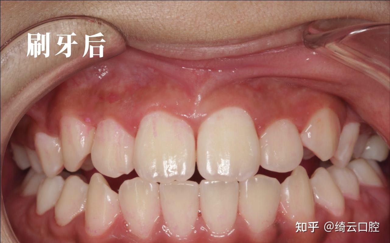 宏观牙石和牙菌斑的特写。牙科中的口腔卫生图片-商业图片-正版原创图片下载购买-VEER图片库