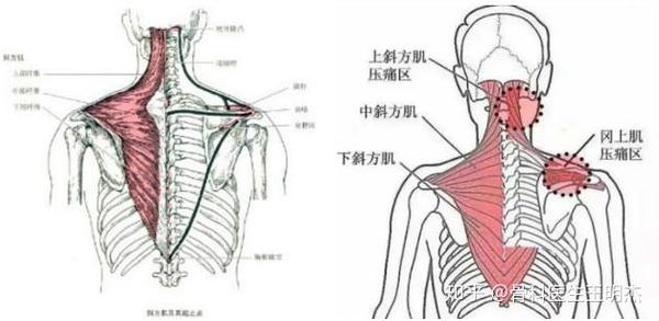 容易被忽视的枕大神经性偏头痛 - 知乎