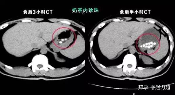 喝完珍珠奶茶照CT真的有阴影,珍珠是塑料做的?
