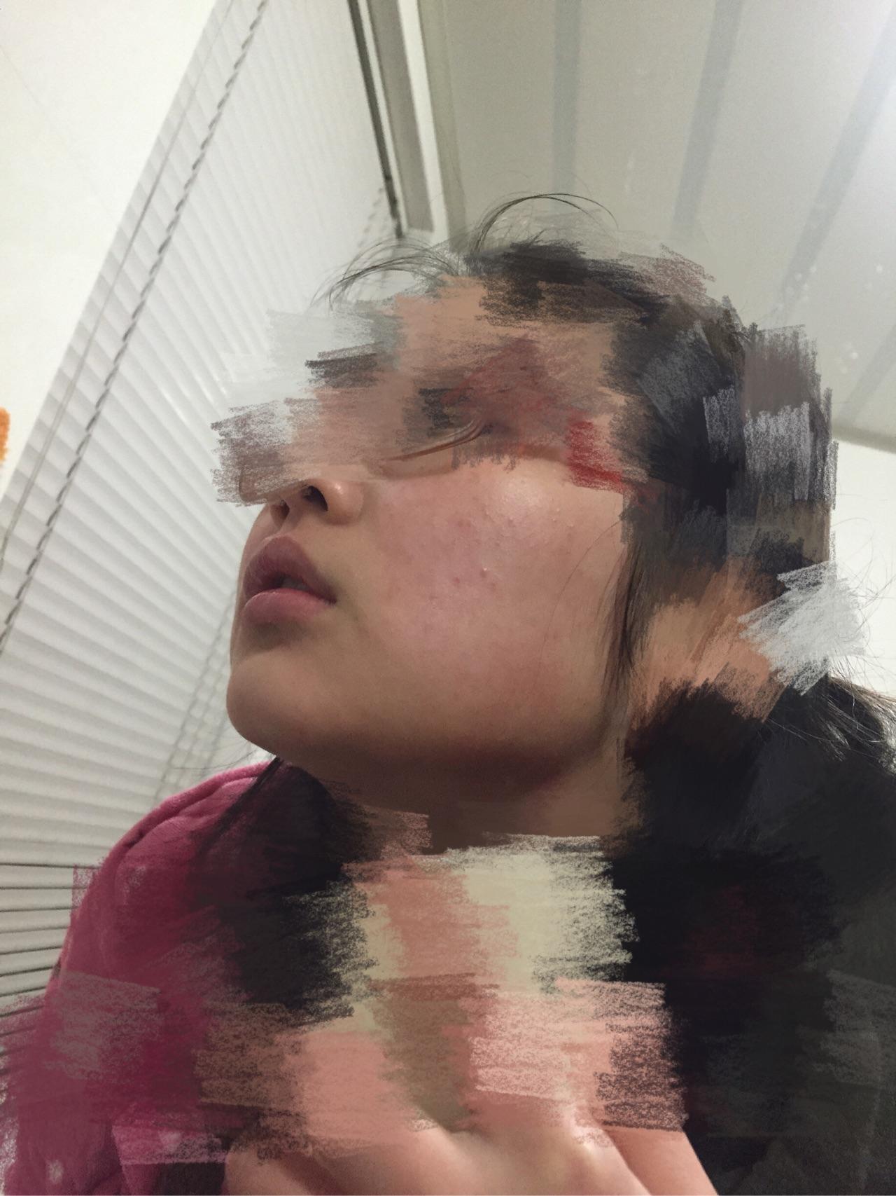 脸上两颊有很多红色小疙瘩还是痘痘?红红的 还