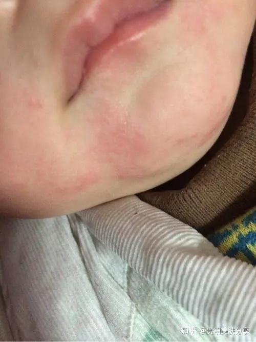 贵阳金肤康皮肤科介绍宝宝下巴长了红红的疹子是湿疹吗