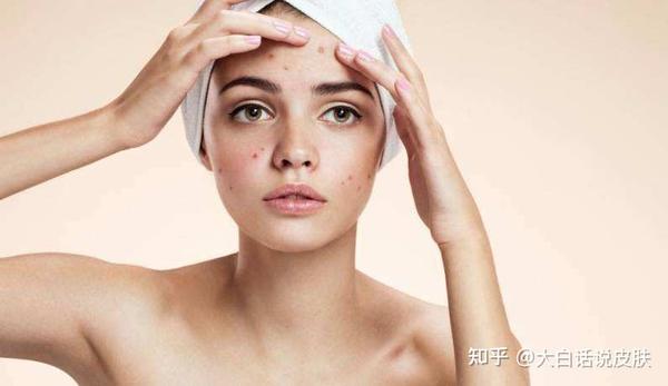 什么是激素脸 知乎 什么是激素脸 知乎