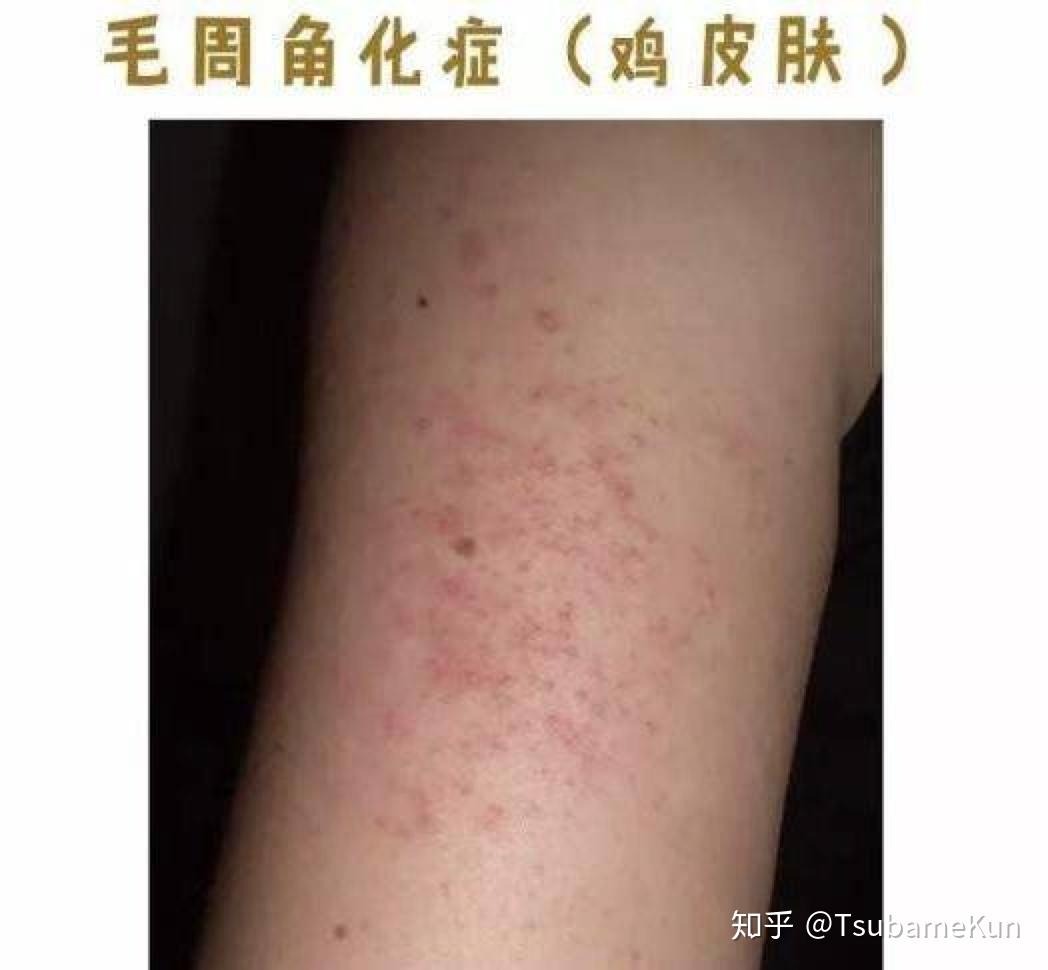 小儿鸡皮肤缺什么维生素(小儿鸡皮肤缺什么维生素B)