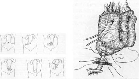 所谓的人工膀胱手术,我们称之为原位新膀胱术,主要是取自患者的回肠