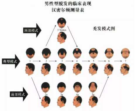 发际线太高怎么办,怎样能降低发际线? - 知乎