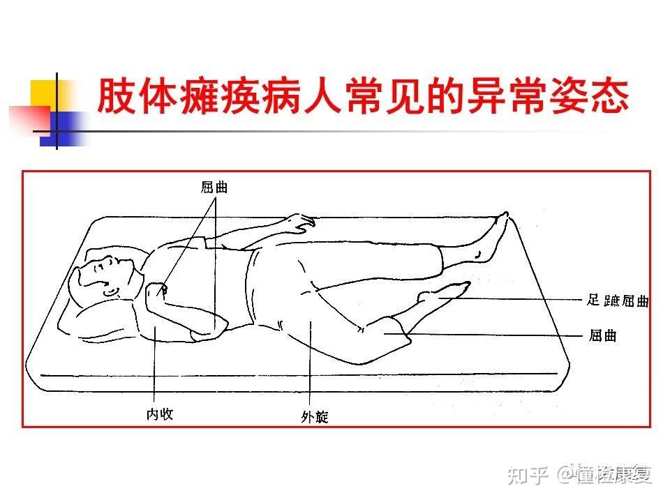 瘫痪肢体的功能位追踪期的护理恢复期的护理急性期的护理护理调整血压