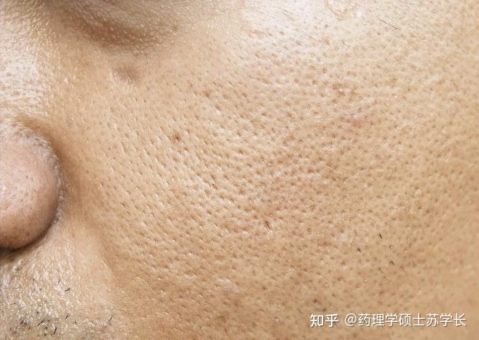 男生脸上毛孔密密麻麻粗大得像蜂窝、还总是出油脏兮兮的,到底应该怎么办?医学生教你4步摆脱粗大毛孔,男生一个月收缩毛孔方法大公开! - 知乎
