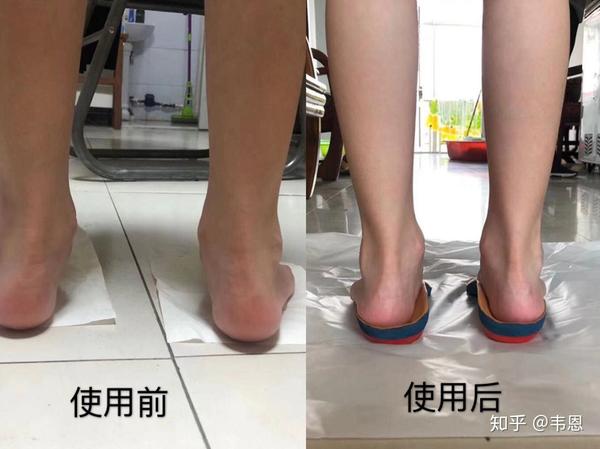 扁平足怎么办?教你一招.