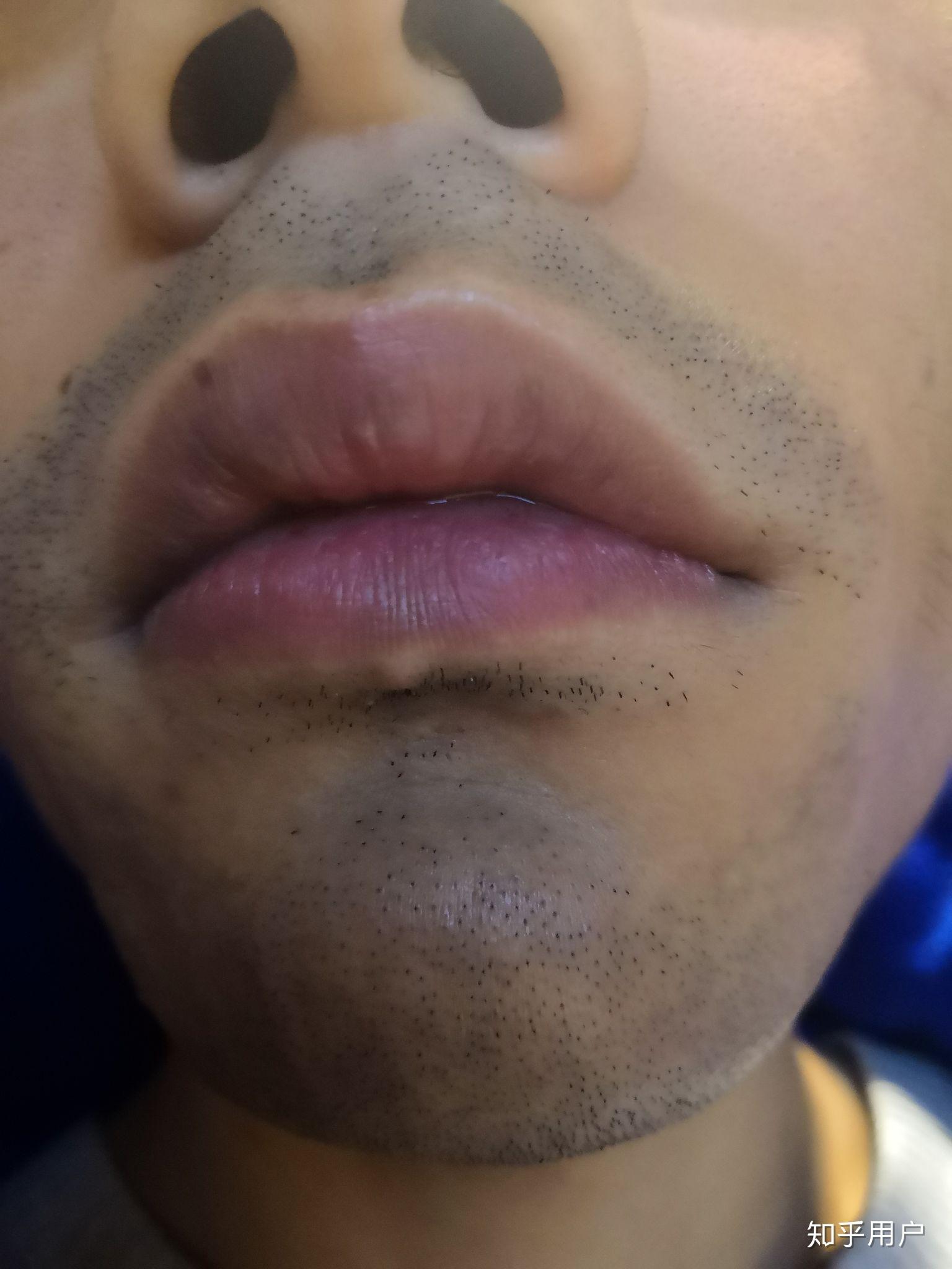 谁知道如何淡化胡青