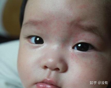 宝宝几个月开始出疹子 v2-ad025b43afecddc9d63c4791dea0b445_r.jpg