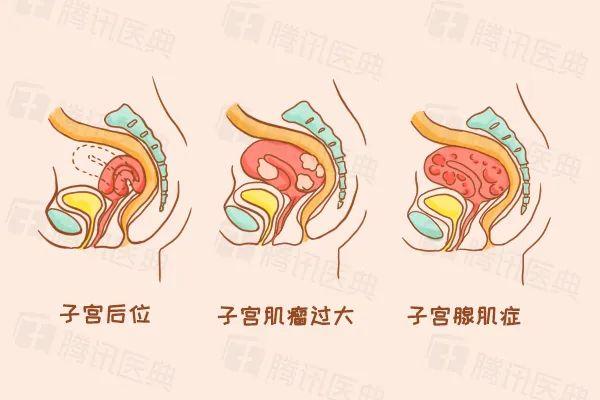 子宫后位压迫直肠图图片