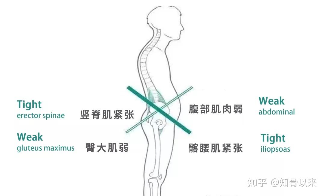 下交叉综合征 挺肚子