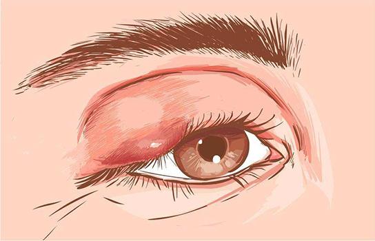 假如你眼睑边缘突然出现一个红红的肿块,你最先想到的就是很可能得了
