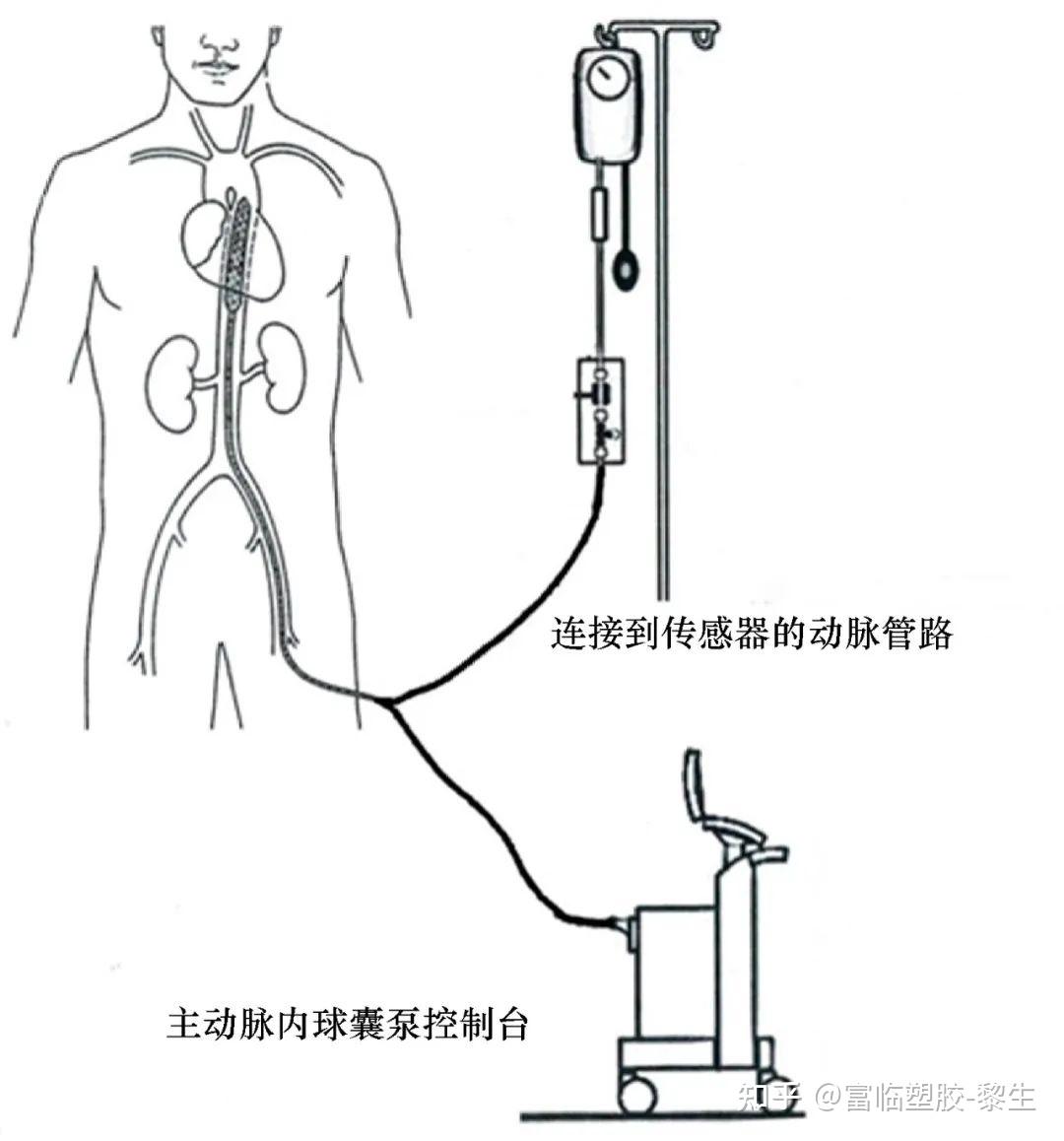 用于心脏病患者的主动脉内聚氨酯球囊反搏泵(iabp):现有技术和临床
