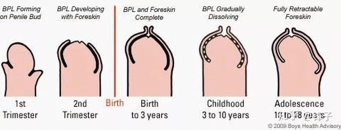随着孩子年龄的增加,包皮口会逐渐自行松解,包皮也自然会与阴茎头分离