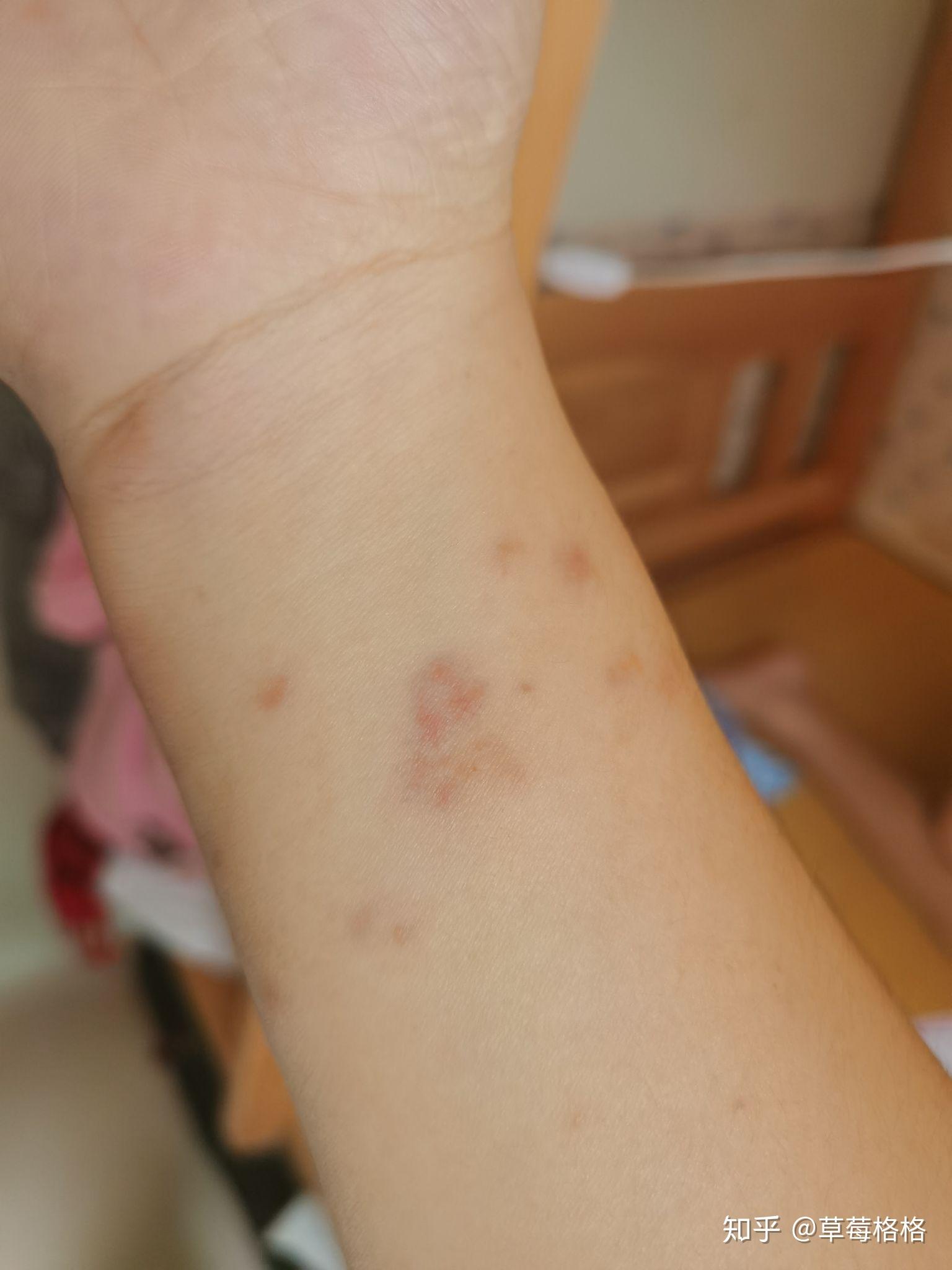 这是咬后第三天的样子,开始是鼓一个包,先是手中毒,再到脚,全身!