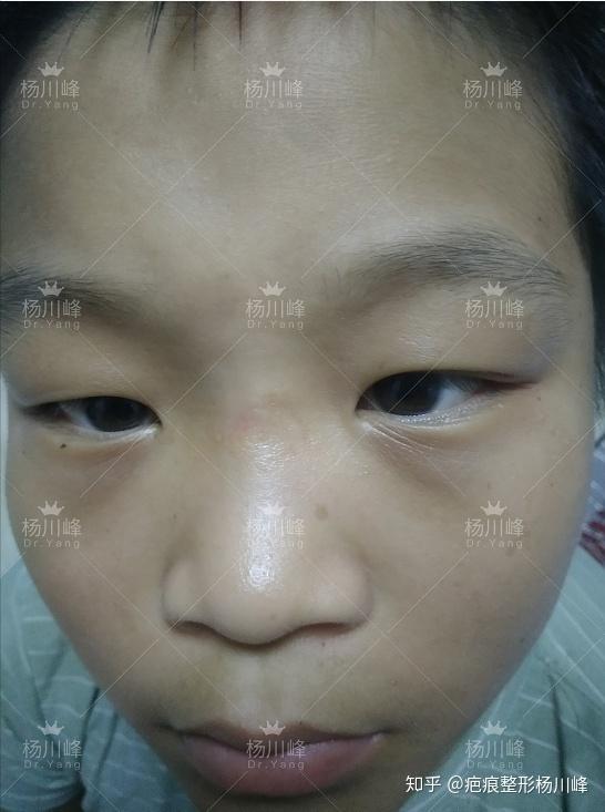小男孩比较调皮所以鼻子上有了一个明显的疤色素沉着记录一下过程共勉