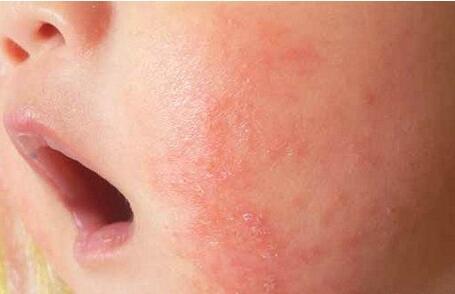 婴儿湿疹是由内,外因素引起的皮肤炎症反应,会反复发作,与遗传过敏