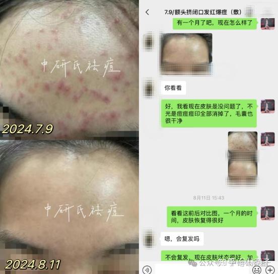 爆痘警告!别再针清闭口粉刺了,闭口不挤一样会能消掉! - 知乎